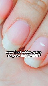 6.1K views · 91 reactions | Ever had white spots on your fingernails? These are some key signs of deficiencies in certain nutrients #deficiency #nutritionaldeficiencies #fingernails #vitaminb12 #healthindicators #healthsigns #vitamin #nutrients #deficiency #healthyliving | Hackyourhealthnow | Facebook