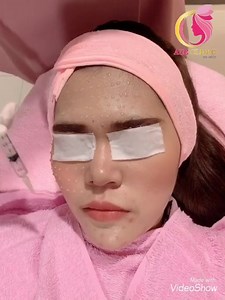 🦋เมโสหน้าใส 499.-🦋 ซื้อ 1 แถม1 ถึง 31 ตุลาคมนี้ เท่านั้น เมโสหน้าใส เป็นการสะกิดตัวยาบนผิว กระจ่ายทั่วใบหน้า แต่ไม่ทำให้เกิดแผล | AC Clinic เสริมจมูก เสริมคาง ปากกระจับ ศัลยกรรมความงาม ปรับรูปหน้า