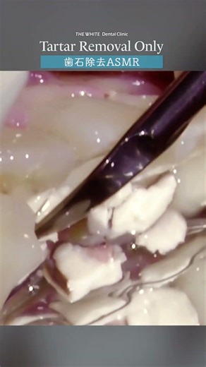 歯石除去ASMR Tartar Removal Only Part2 #ザホワイトデンタルクリニック #歯医者 #歯石除去 #歯石