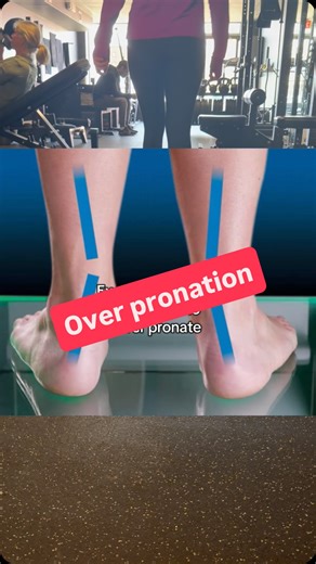 Lisa Mitro, Physical Therapist for Runners on Instagram: "When a runner can’t control pronation, the foot will compensate because pronation is a necessity during mid stance of gait. In some cases you can have pain on the inside of the ankle or even outside of ankle depending how the body compensates Over pronation is really just eversion of the foot, not true pronation. Over time this can even cause a bunion Over pronation doesn’t mean you’re going to have foot or ankle pain but it can contribut