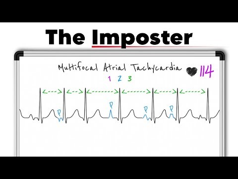 Multifocal Atrial Tachycardia (MAT) Explained | ECG Interpretation Made Easy