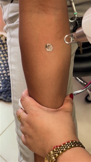 Laser tattoo removal Coin size 499! | Z Brows Beauty Studio