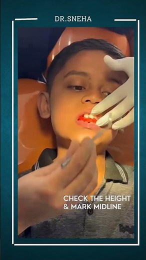 Construction bite for Twin Block appliance/Orthodontics/ Functional appliance #dentistry#ortho#reels