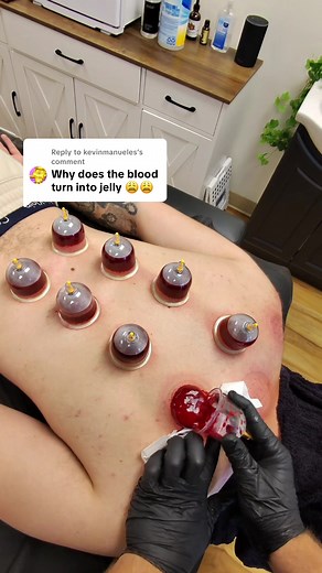 Understanding Blood Clotting Mechanisms