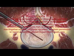 Lumbar Transpedicular Discectomy