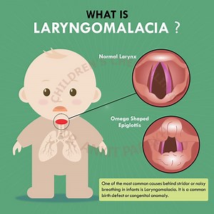 What is laryngomalacia? - Dr. Ankit Parakh – India's best Pediatric Pulmonologist | Chest Specialist