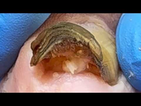 Toenail Curling Up With A Black Edge, Remove The Damaged Nail【Xue Yidao】
