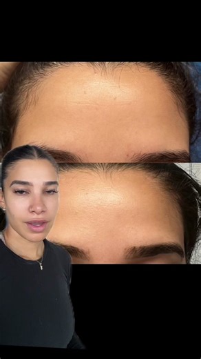 Effective Ways to Remove Forehead Lines Without Botox