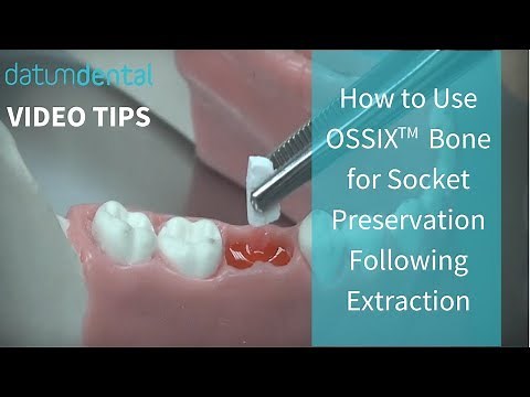 Video Tips: How to Use OSSIX Bone for Socket Preservation Following Extraction
