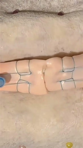 tendon repair technique