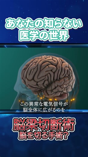 【話したくなる医学雑学】脳を切断する手術！？現在も行われている左脳と右脳を分離する手術！！～あなたの知らない医学の世界～ #雑学