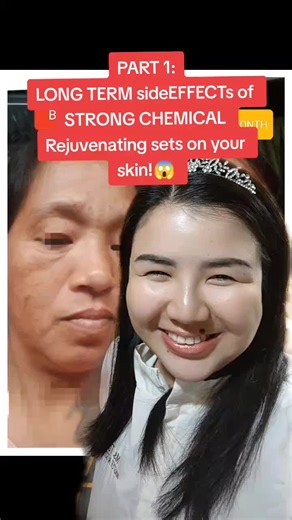 side effects of using strong chemical rejuv sets or products for several months. #beyouturaloragnicsph #rejuvenatingset #melasmaskincare #melasma #melasma #organicskincare #organics