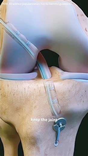 Knee (ACL) Surgery #knee #Anterior #Cruciate #Ligament #pain #treatment #procedure #3danimation