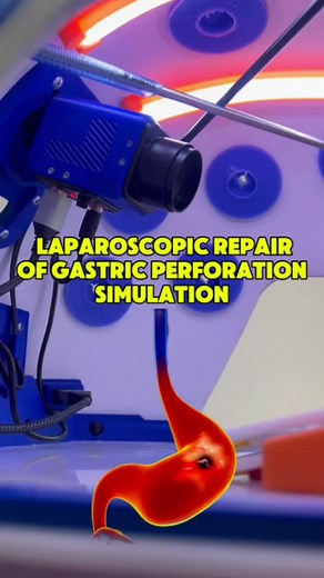 Gastric Perforation Laparoscopic Repair