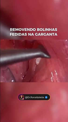 COMO REMOVER BOLINHAS BRANCAS DA GARGANTA