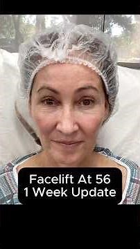 Facelift At 56 - 1 Week Update (Interview) #facelift
