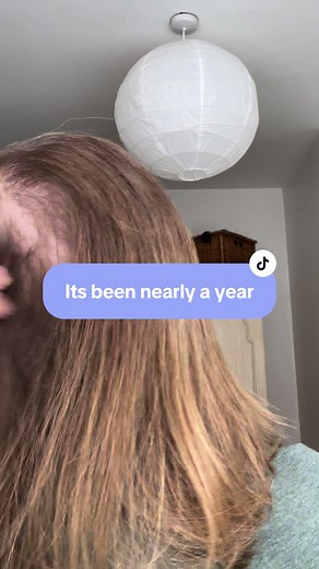 Oral Minoxidil and Spironolactone Journey: 6-Month Update