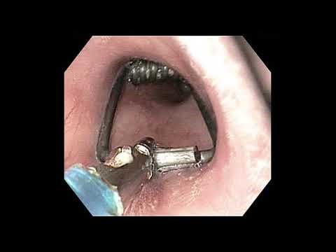 UPPER GI ENDOSCOPY + FOREIGN BODY EXTRACTION