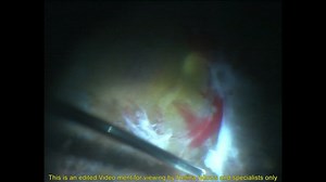 "One-handed" High Speed Dissections and ILM Peeling for PDR - Eyetube