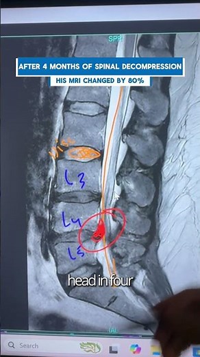 Disc Extrusion Reduced 80% in 4 Months with Spinal Decompression - No Surgery #BackPain