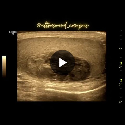 #generalelectricultrasound #generalelectrichealthcare #gee9 #logice9 #ceus #contrastenhancedultrasound #icussociety #sonovue #ultrasoundcampus #urology #menshealth #sonography | Prof. Dr. Dirk André Clevert, MHBA