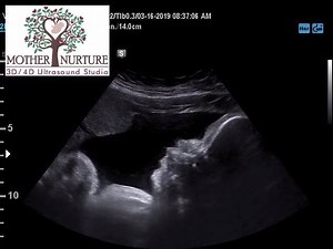 7.3K views · 78 reactions | This baby had quite the case of hiccups today! | Mother Nurture Ultrasound | Facebook