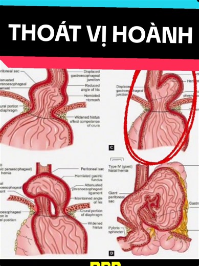 Một ca thoát vị hoành #drtranhaivu #radiology #chandoanhinhanh #xray