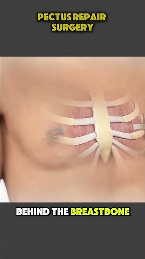 How Pectus Excavatum Repair Surgery Is Done | Step-by-Step Surgical Procedure #PectusExcavatum