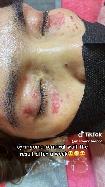 Syringoma Removal and Electrocauterization at Angel Beauty Skin Clinic