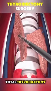 67K views · 380 reactions | Thyroidectomy Surgery (3D Animation) #facts #randomfacts #learnontiktok #curiosity #satisfying #satisfyingvideos | MindfulFacts | Facebook