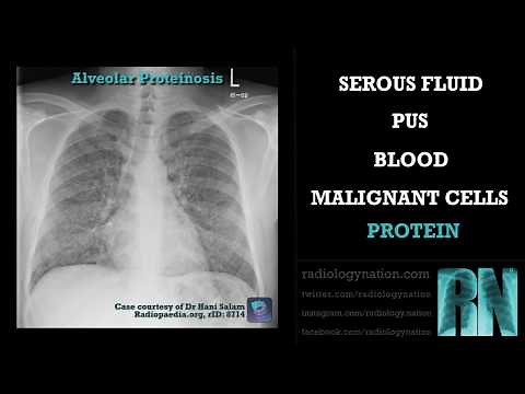 Radiograph Tutorial: Chest X-ray / CXR consolidation | Radiology Nation