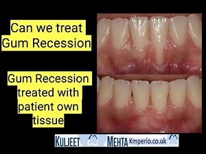 Treatment of Gum Recession After Orthodontic • Video • MEDtube.net