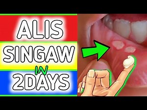 Isang PINAKA MABISANG GAMOT SA SINGAW | GUMALING ANG SINGAW IN 2DAYS LANG. #fy #fyp #cankersores