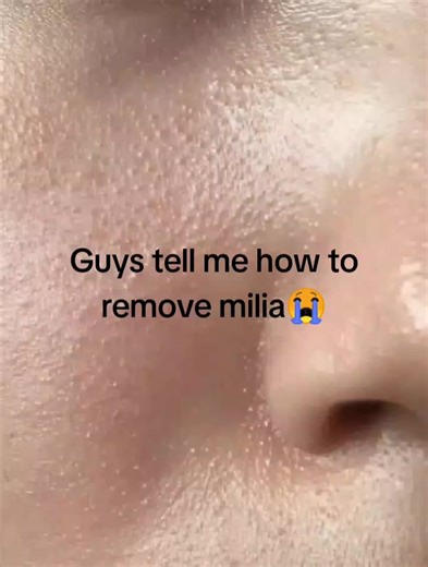 How to Remove Milia: Effective Tips and Tricks