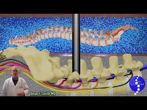 What is a MicroDiscectomy?