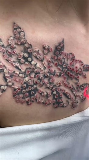 Remove a very large tattoo, and it's done