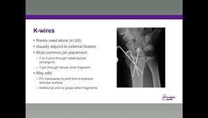 Avoiding Complications: Dorsal Plates, K-Wires and External Fixation