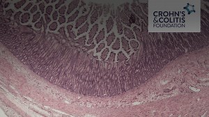 Virtual IBD Clinic: Disease Management and Surgery