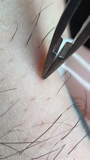 Watch What Happens When You Destroy the Follicle🫢