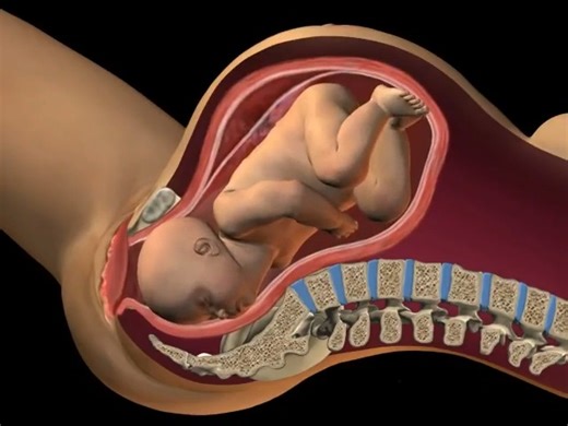 Shoulder dystocia is when the baby's head has been born but one of the shoulders becomes stuck behind the mother's pubic bone, delaying the birth of the baby's body. #Pregnancy #Pregnant #Birth #Childbirth #Naturalchildbirth | Family Life