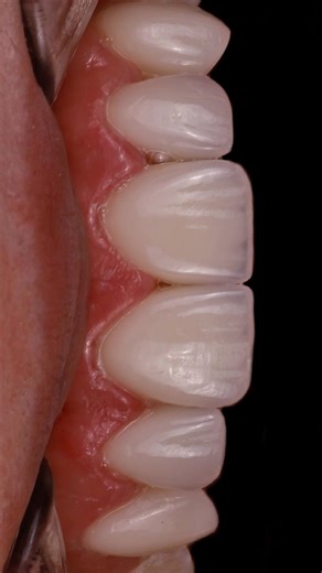 Керамические виниры E.max, Creation, Noritake, рефрактор