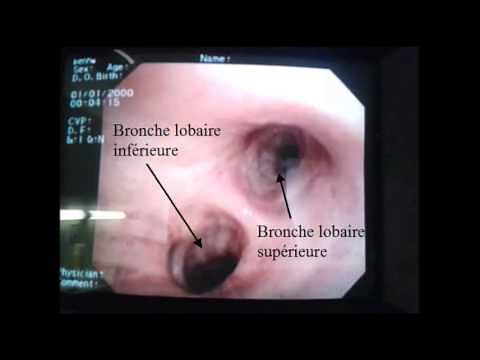 Anatomical basis of bronchoscopy