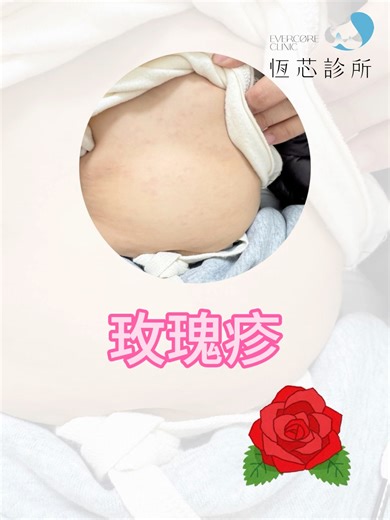 在日本發燒回來，退燒後開始長疹子，依照經驗是玫瑰疹 #恆芯診所 #溝通帶來信任了解才能安心 #兒科醫師洪毓棋 | 兒科醫師洪毓棋
