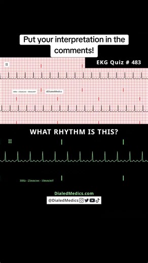🦋🫀🤔 All #EKG recordings are from the EKG rhythm generator on my website (LII rhythms only for now, 12Ls are in beta and coming soon), be sure to check it out for more software generated ECG practice! (Link in bio.) #EMS #paramedic #nurse #doctor