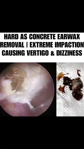 Effective Techniques for Ear Cleaning at Home