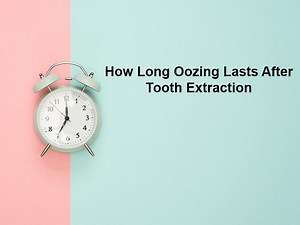 How Long Oozing Lasts After Tooth Extraction (And Why)?