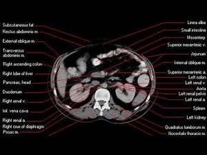 CT SCAN K.U.B full work process on Siemens 128 slice
