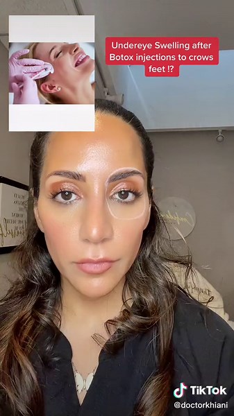 Understanding Swelling After Botox Injections to Crows Feet