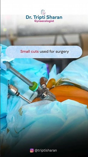 Endometriosis Surgery Explained Simply | Symptoms, Treatment & Recovery #gynecology #doctor #health