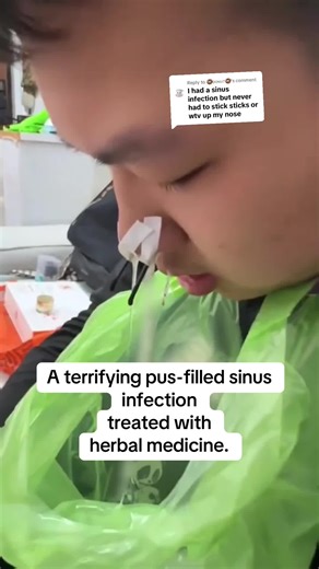 Herbal Treatment for Pus-Filled Sinus Infection